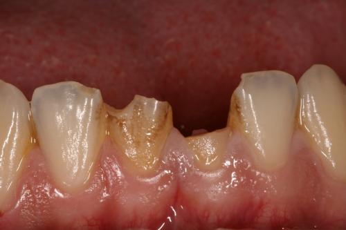 Broken teeth before treatment