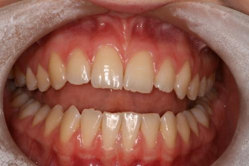 Teeth whitening before
