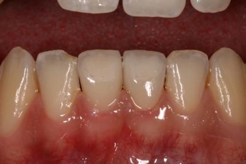 Porcelain crowns to rebuild teeth