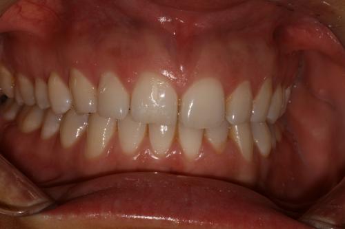 Teeth whitening before