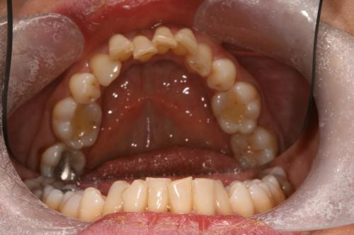 Invisalign straightening before