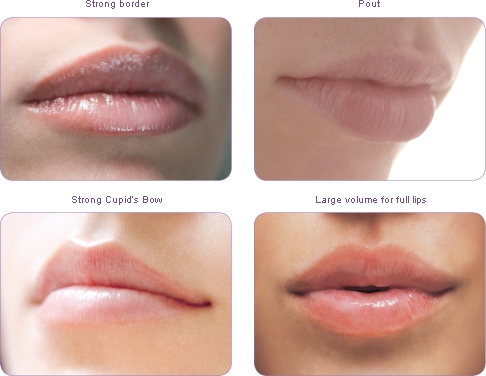 LIP ENHANCEMENT WITH DERMAL FILLERS