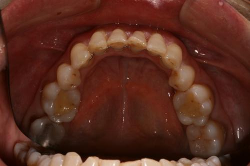 Invisalign straightening after