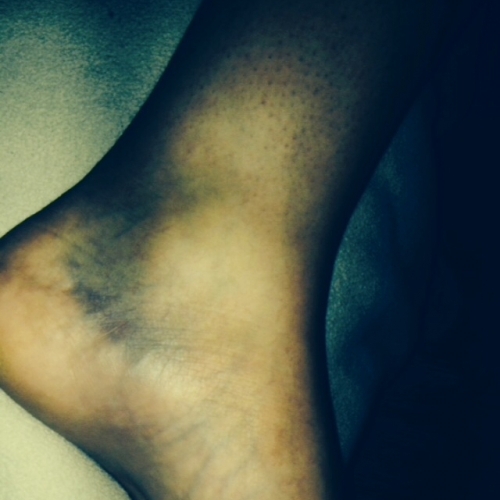 Photo 3 Injury Showing Extensive Bruising To Ankle