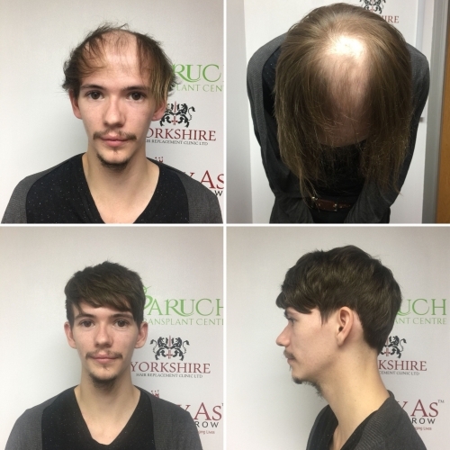 Patient undergoes a non surgical hair transplant  to replace his hair.