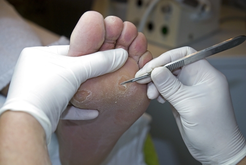 Dreamstime Xs 12236775 Removing Hard Skin On Foot With Scalpel