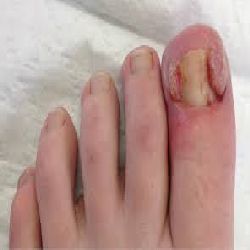 ingrown toe nails in bexley