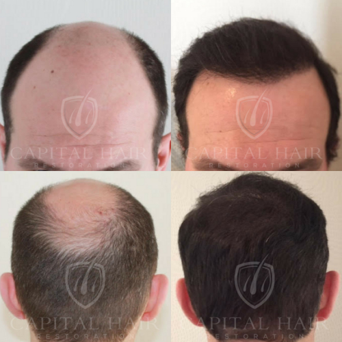 FUE hair transplant